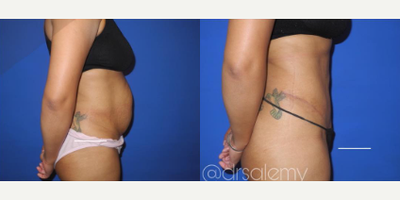 Case 1502 - Woman treated with Tummy Tuck