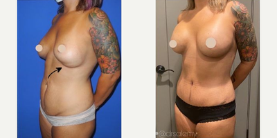 Case 1503 - Woman treated with Breast Implants, Tummy Tuck