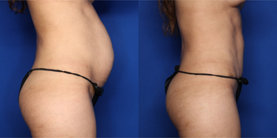 Case 1504 - 35-44 year old woman treated with Tummy Tuck