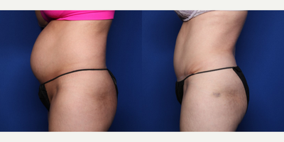 Case 1505 - 35-44 year old woman treated with Tummy Tuck