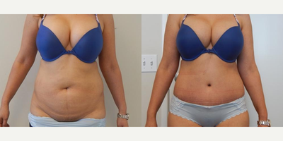 Case 1506 - 25-34 year old woman treated with Tummy Tuck