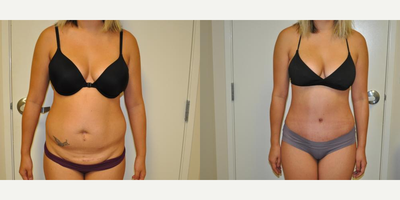 Case 1507 - 25-34 year old woman treated with Tummy Tuck