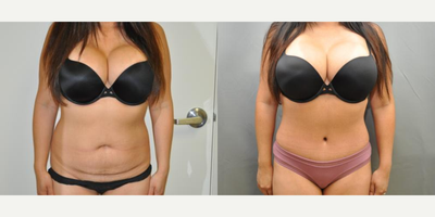 Case 1508 - 35-44 year old woman treated with Tummy Tuck