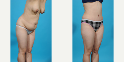 Case 1509 - 25-34 year old woman treated with Diastasis Recti Repair and Tummy Tuck