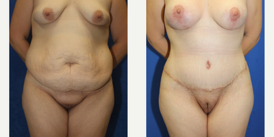 Case 151 - 25-34 year old woman treated with Tummy Tuck