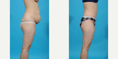 Case 1510 - 25-34 year old woman treated with Diastasis Recti Repair and Tummy Tuck