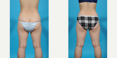 Case 1511 - 25-34 year old woman treated with Diastasis Recti Repair and Tummy Tuck