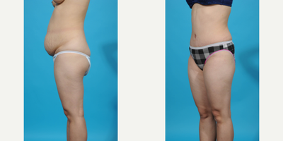 Case 1512 - 25-34 year old woman treated with Diastasis Recti Repair and Tummy Tuck