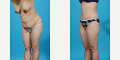 Case 1513 - 25-34 year old woman treated with Diastasis Recti Repair and Tummy Tuck