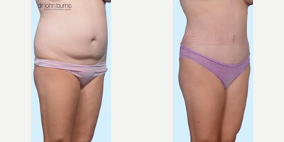 Case 1514 - Woman treated with Tummy Tuck