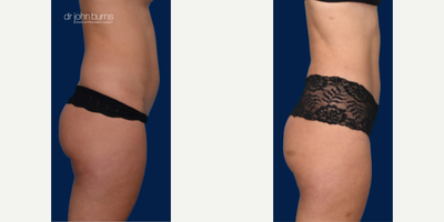 Case 1515 - Woman treated with Tummy Tuck