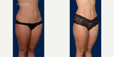 Case 1516 - Woman treated with Tummy Tuck