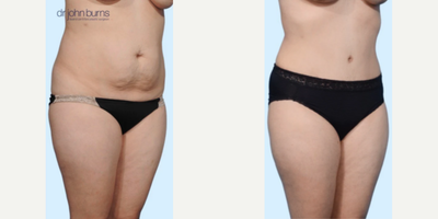 Case 1517 - Woman treated with Tummy Tuck