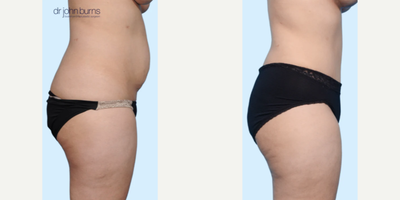 Case 1518 - Woman treated with Tummy Tuck