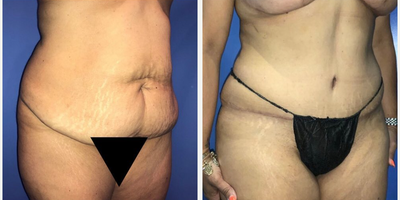 Case 1529 - Woman treated with Tummy Tuck, Liposuction