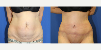 Case 154 - Woman treated with Tummy Tuck