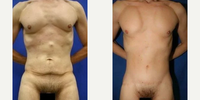 Case 155 - 45-54 year old Man treated with Tummy Tuck