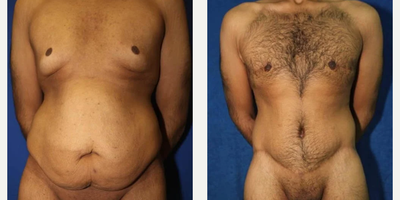 Case 156 - Man treated with Tummy Tuck