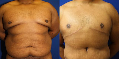 Case 1560 - 25-34 year old man treated with Tummy Tuck