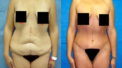 Case 1561 - 25-34 year old woman treated with Tummy Tuck