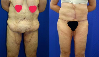 Case 1562 - 35-44 year old woman treated with Tummy Tuck