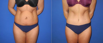 Case 1563 - Woman treated with Tummy Tuck