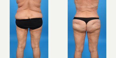 Case 1564 - 35-44 year old woman treated with Tummy Tuck