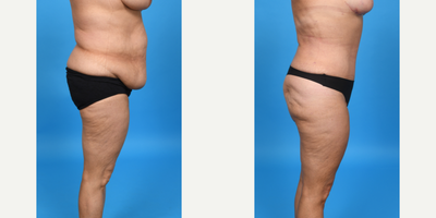 Case 1565 - 35-44 year old woman treated with Tummy Tuck