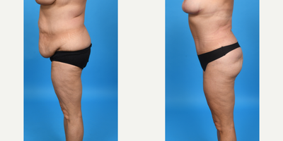 Case 1566 - 35-44 year old woman treated with Tummy Tuck