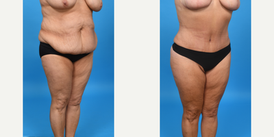 Case 1567 - 35-44 year old woman treated with Tummy Tuck