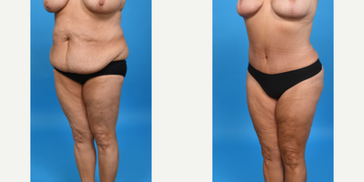 Case 1568 - 35-44 year old woman treated with Tummy Tuck