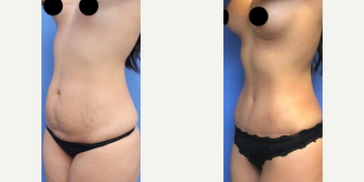 Case 1569 - Woman treated with Breast Augmentation, Tummy Tuck, Liposuction, Mommy Makeover