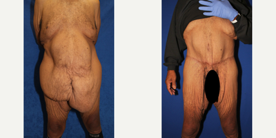 Case 157 - Man treated with Tummy Tuck