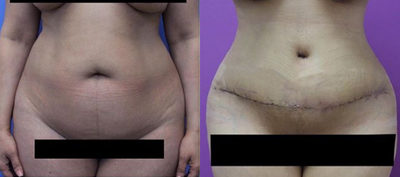 Case 1570 - Woman treated with Tummy Tuck