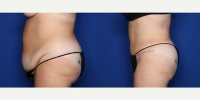 Case 1572 - 45-54 year old woman treated with Tummy Tuck