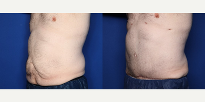 Case 1573 - 35-44 year old man treated with Tummy Tuck