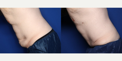 Case 1574 - 35-44 year old man treated with Tummy Tuck