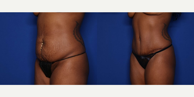Case 1576 - 25-34 year old woman treated with Tummy Tuck