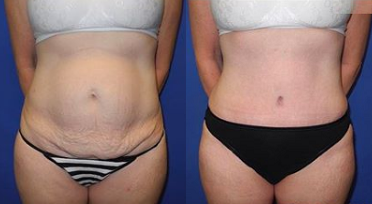 Case 1578 - Woman treated with Tummy Tuck