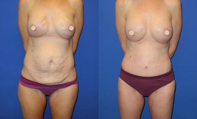 Case 1579 - Woman treated with Tummy Tuck