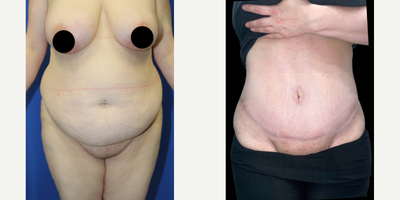 Case 158 - Woman treated with Tummy Tuck