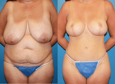 Case 1580 - Woman treated with Tummy Tuck