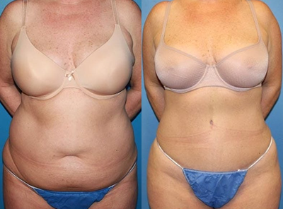 Case 1581 - Woman treated with Tummy Tuck