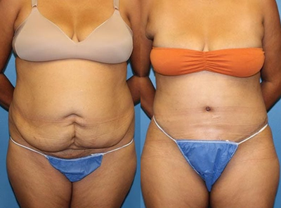 Case 1582 - Woman treated with Tummy Tuck