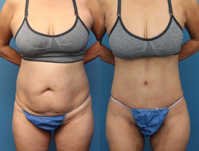 Case 1583 - Woman treated with Tummy Tuck