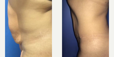 Case 1584 - Woman treated with Tummy Tuck