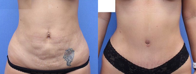 Case 1586 - Woman treated with Tummy Tuck