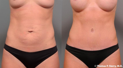 Case 1588 - 29 year old woman treated with Tummy Tuck