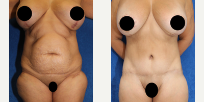Case 1589 - 45-54 year old woman treated with Tummy Tuck