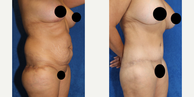Case 1590 - 45-54 year old woman treated with Tummy Tuck